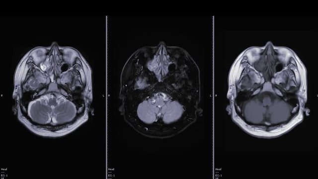Collection of magnetic resonance imaging or MRI brain scan in axial view 