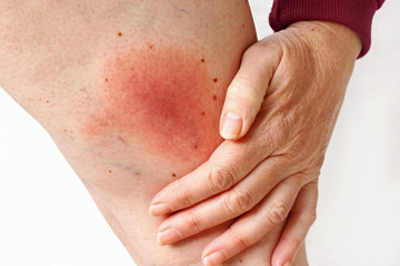 Wanderröte durch eine Zecke übertragene Lyme-Borreliose Erkrankung am Bein einer Frau. Borreliose...