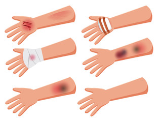 Set of injury arms
