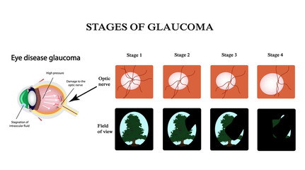Glaucoma. The structure of the eye. The field of vision in glaucoma. Atrophy of the optic nerve. Infographics. Vector illustration on isolated background
