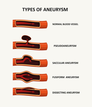 Types of aneurysm