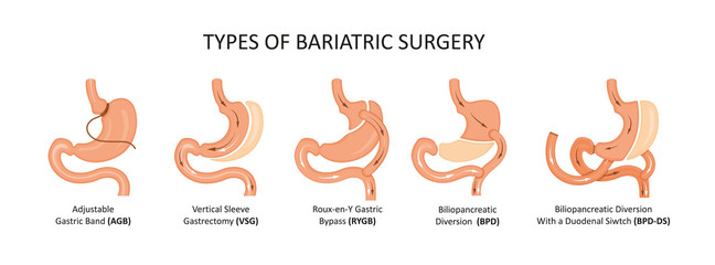Types of bariatric surgery. Stomach reduction - obrazy, fototapety, plakaty