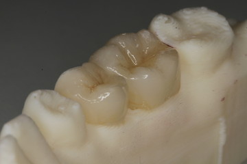Ceramic Protesis teeth 