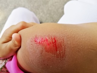 Bruised wound injury on woman knee background