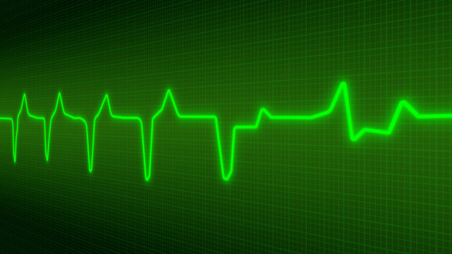 Electrocardiogramme
