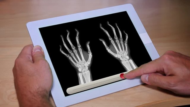 A doctor or patient uses a touchscreen tablet PC to simulate the progression of rheumatoid arthritis on a pair of hands.  	