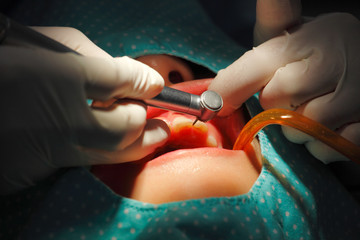 Closeup dental deep cleaning by scaling plaque from patient teeth  
