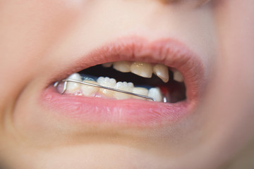 Fototapeta premium Photo of a little girl's mouth with an orthodontic appliance and crooked teeth.