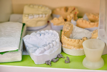 Gypsum model with teeth stump and implant