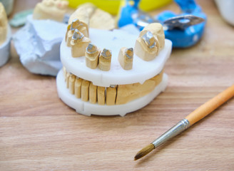Gypsum model with teeth stump and implant