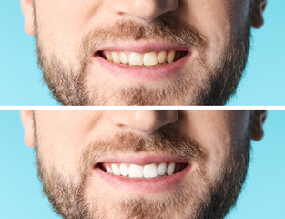 Obraz premium Smiling man before and after teeth whitening procedure on color background, closeup