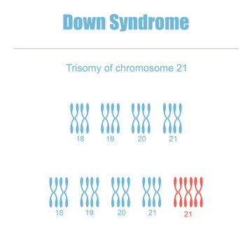 Trisomy of chromosome 21