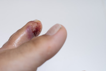 Finger on the leg. Purulent finger. Wound close up. purulent wound