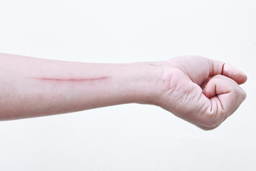 pain and itching from the wound because scratch is long on the arm.