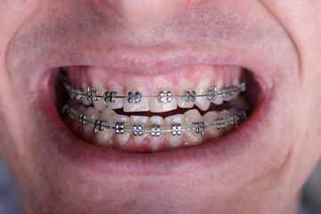 Metal orthodontic braces on crooked ugly teeth close-up. Ugly smile. Dental concept, medicinal...