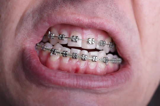 Metal orthodontic braces on crooked ugly teeth close-up. Ugly smile. Dental concept, medicinal alignment of teeth, brackets orthodontist
