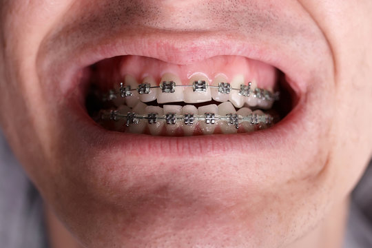 Metal orthodontic braces on crooked ugly teeth close-up. Ugly smile. Dental concept, medicinal alignment of teeth, brackets orthodontist