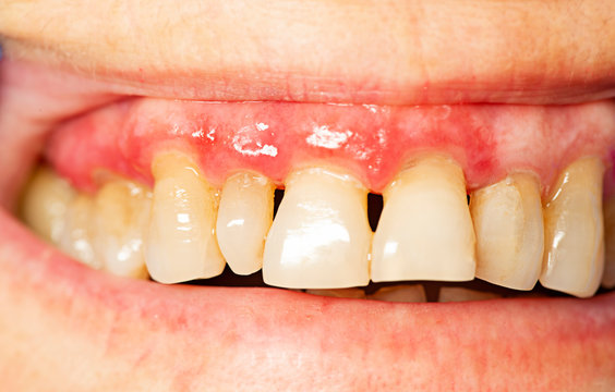 Teeth With Periodontitis Close Up