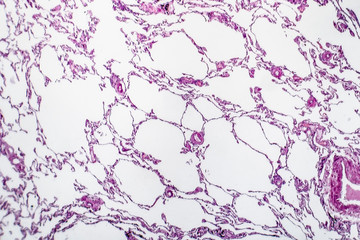 Histopathology of lung emphysema, light micrograph, photo under microscope showing enlargement of...