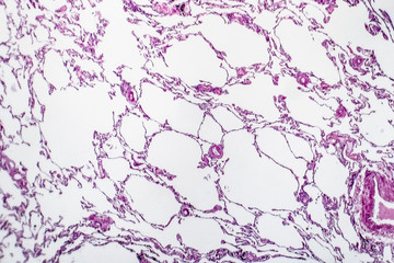 Histopathology of lung emphysema, light micrograph, photo under microscope showing enlargement of...