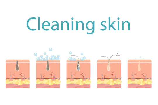 Facial Skin Care, Pore Cleaning. Cleansing Stages On Clogged Face. Skin Cleaning Steps. Vector Illustration.