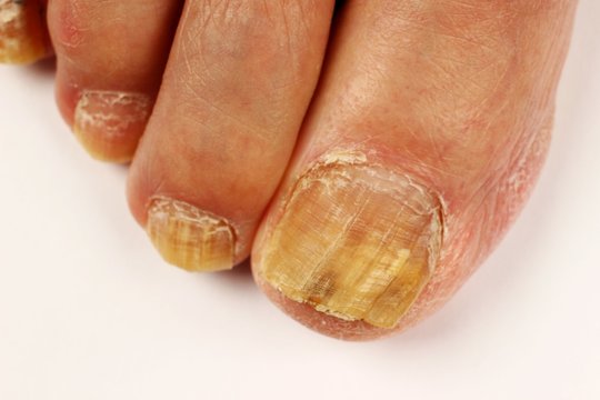 Nail fungus infected feet close up