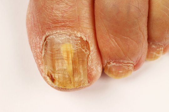 Fungus on the toenails on a white background