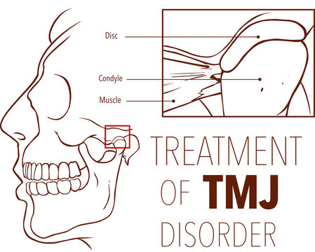 Vector illustration  of treatment of tmj disorder
