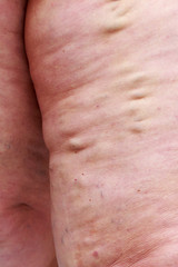 Fototapeta premium The varicose veins