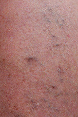 Fototapeta premium The varicose veins
