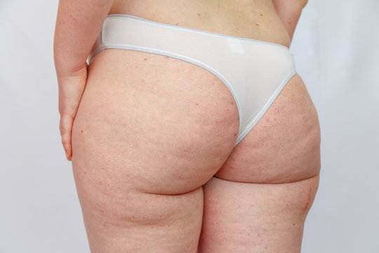 28 year old Caucasian overweighted woman in lingerie shows places with excess fat, irritation and cellulite on the hips,buttocks and abdomen . Concept for medicine and cosmetology