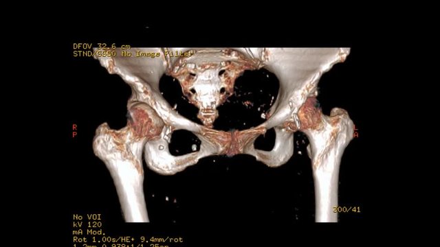 CT SCAN  of  Both hip joint 3D rendering image Rotating on the screen  from patient case trauma .