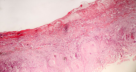 Histopathology of tuberculous pleurisy, light micrograph, photo under microscope