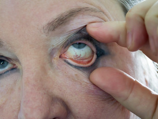 The eyes of a woman are wide open with the hand of a doctor. Swollen and reddened veins are visible...