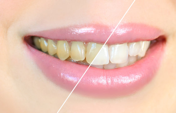 Teeth whitening effect, before and after
