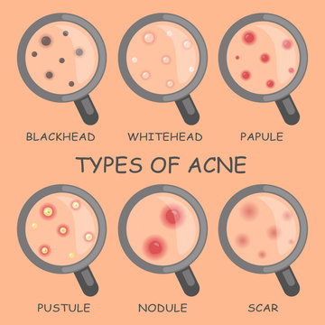 Acne Skin Diagram Images – Browse 921 Stock Photos, Vectors, and Video | Adobe Stock
