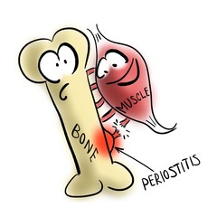 Periostitis or shin splints