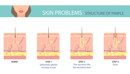 Stages of the acne formation in the human skin. Skin layer with acne. Vector illustration.
