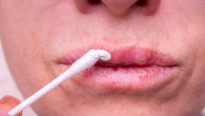 Treatment of herpes on lips with ointment close-up.