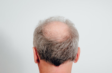 Rear view of a male head without hair. Hair loss concept, bird's nest on the head. Problems with hair regrowth, shampoo for facial hair growth.
