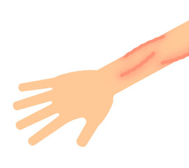 腕のミミズ腫れ