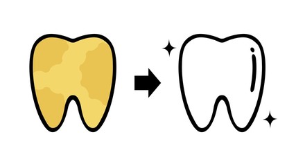 歯のホワイトニング