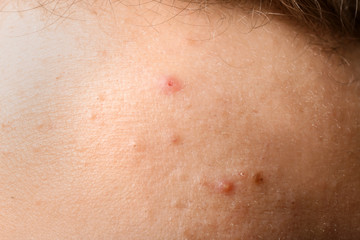 Naklejka premium Teenager with acne problem, closeup