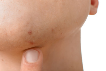 Fototapeta premium Teenager with acne problem, closeup