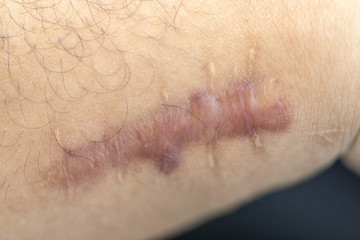 A scar is an area of fibrous tissue that replaces normal skin after an injury on skin. 