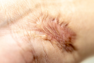 A scar is an area of fibrous tissue that replaces normal skin after an injury on skin. 