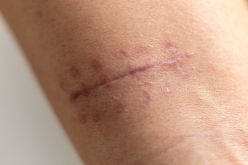 Fototapeta premium A scar is an area of fibrous tissue that replaces normal skin after an injury on skin. 