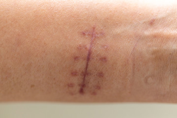 A scar is an area of fibrous tissue that replaces normal skin after an injury on skin. 