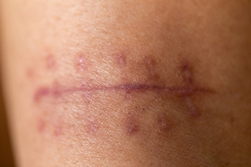 A scar is an area of fibrous tissue that replaces normal skin after an injury on skin. 