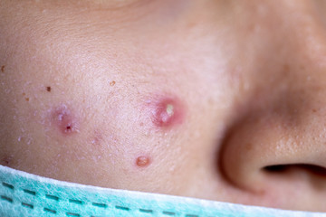 Backgrounds of lesions skin caused  by acne on the face in the clinic.